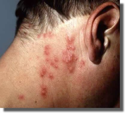 Urticaire processionaire du chêne Urticaire processionaire du chêne